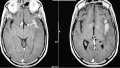 Meningitis tuberculosa en paciente VIH positivo