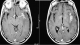 Meningitis tuberculosa en paciente VIH positivo