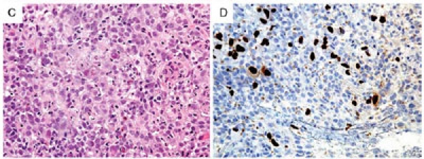 Uso de biología molecular para detección de CMV en las muestras de biopsia digestiva