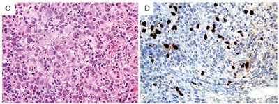 Uso de biología molecular para detección de CMV en las muestras de biopsia digestiva