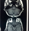 Tuberculomas. Síndrome inflamatorio de reconstitución inmune (SIRI) paradojal