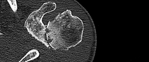 Osteoartritis crónica de hombro