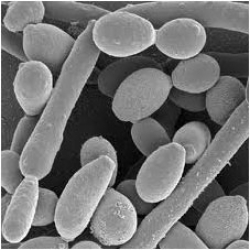 Candidiasis esofágica