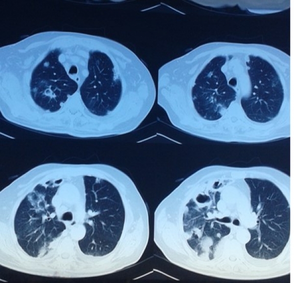 Infección por Staphylococcus aureus meticilino sensible