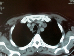 Toxicidad por fármacos. Co infección TB VIH