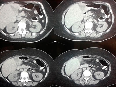 Manejo de infecciones invasivas por Candida en pacientes quirúrgicos