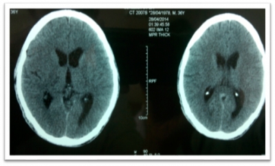 Meningitis tuberculosa en inmunodeprimido