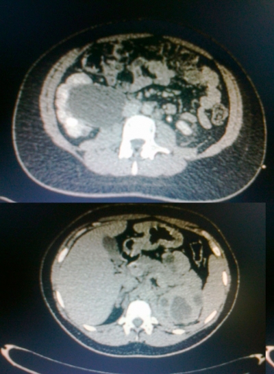 Pielonefritis asociada a urolitiasis complicada con abscesos renales secundaria a Proteus mirabilis