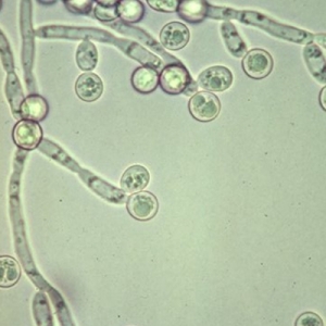 Candidiasis esofágica