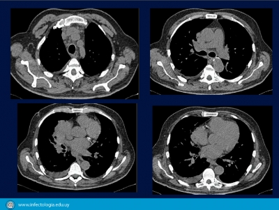 Tuberculosis – Micobacteriosis grave