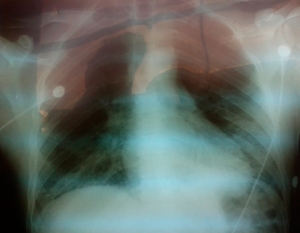 Pneumocystosis en trasplantado renal