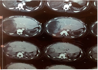 Peritonitis terciaria. Enterobacterias multiresistentes, manejo antibiótico