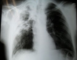 Aspergilosis pulmonar